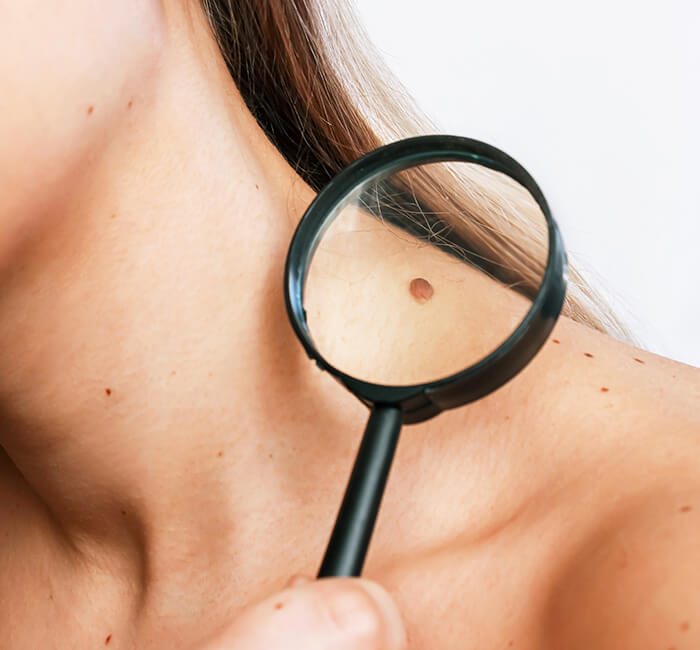 Benefits of Mole Removal Treatment in Mumbai