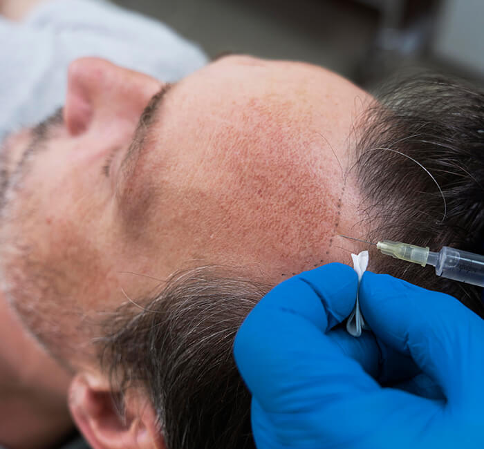 Benefits of Scalp Micropigmentation in Mumbai