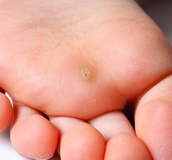 Procedure of Wart Removal Treatment