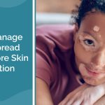 Tips to Manage Vitiligo Spread and Restore Skin Pigmentation