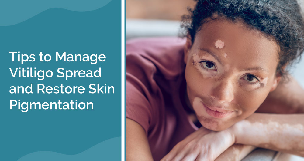 Tips to Manage Vitiligo Spread and Restore Skin Pigmentation