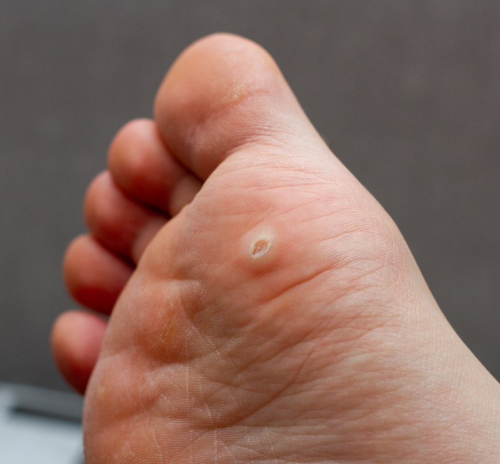 Benefits Wart Removal Treatment