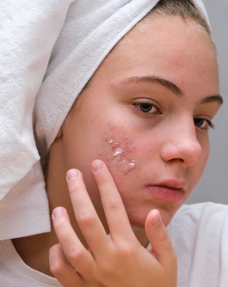 acne scar treatment