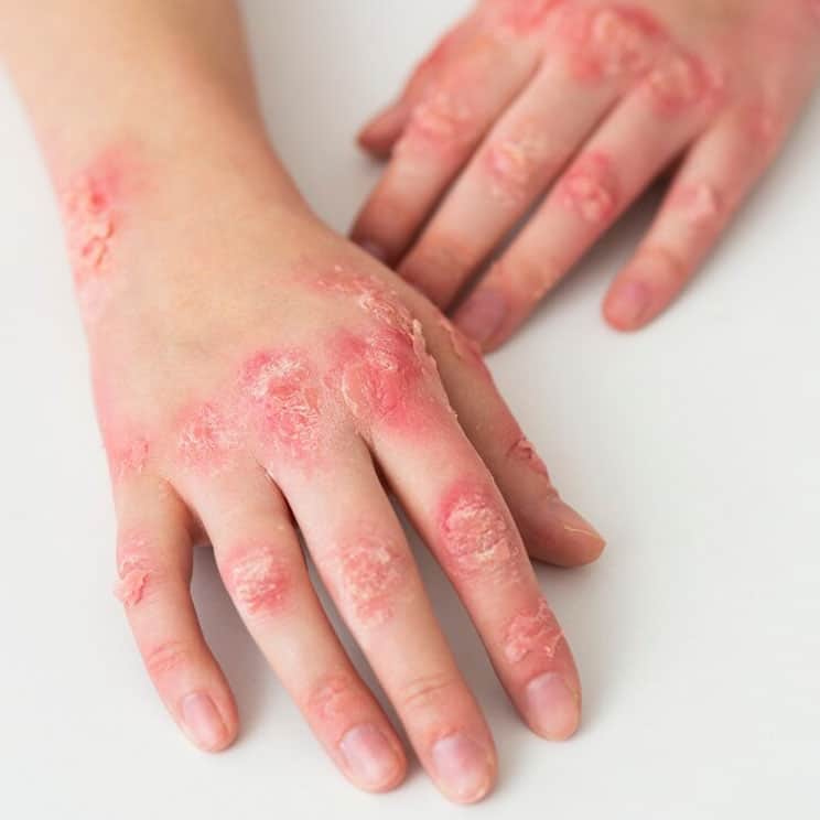 atopic eczema