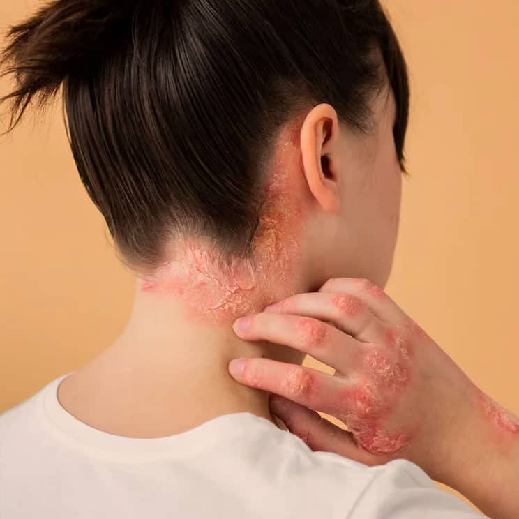 auro skin psoriasis treatment