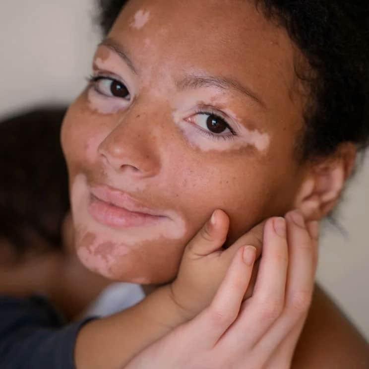 auro skin vitiligo treatment