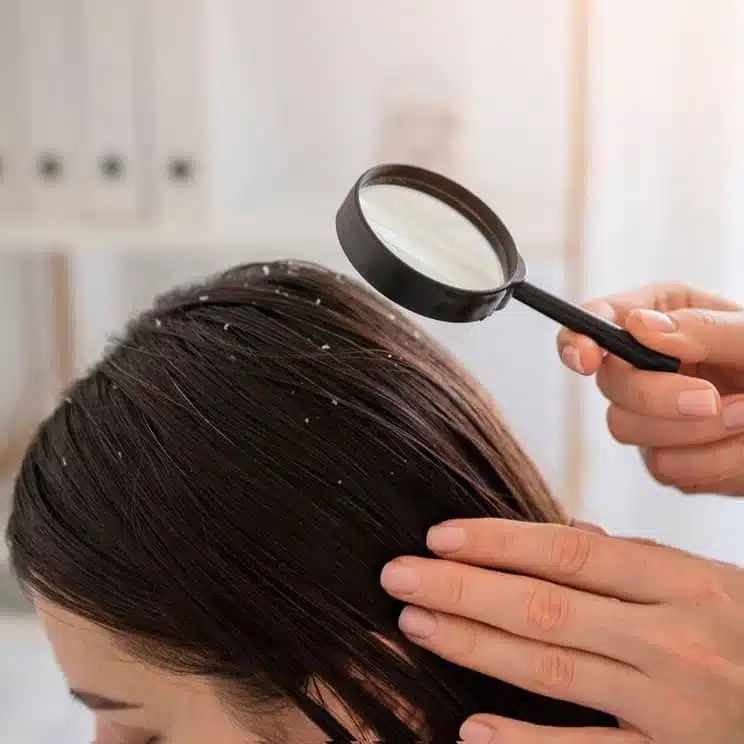 dandruff treatment