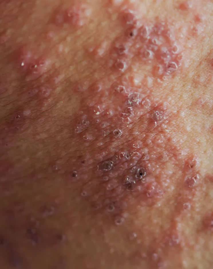 drug rashes treatment