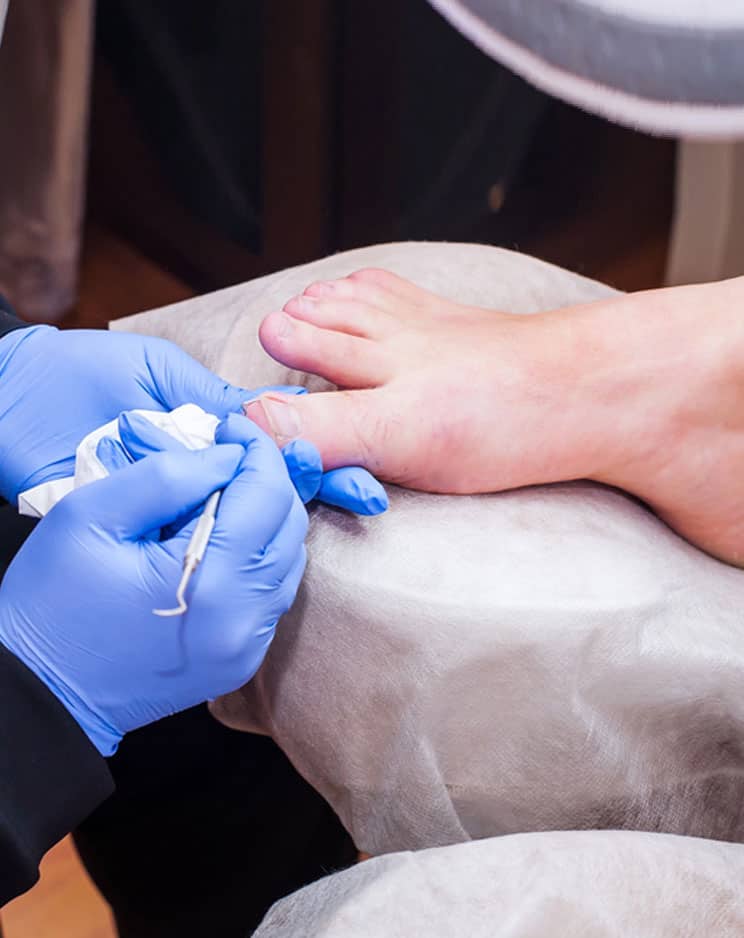 ingrown toenail treatment