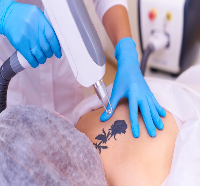 laser-tattoo-removal-cosmetology-clinic (1)