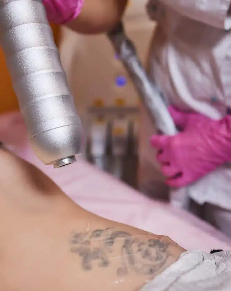 laser tattoo removal treatment