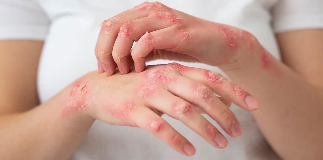 psoriasis treatment