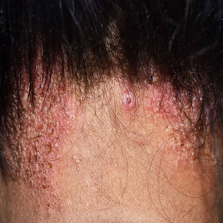 recurrent folliculitis treatment