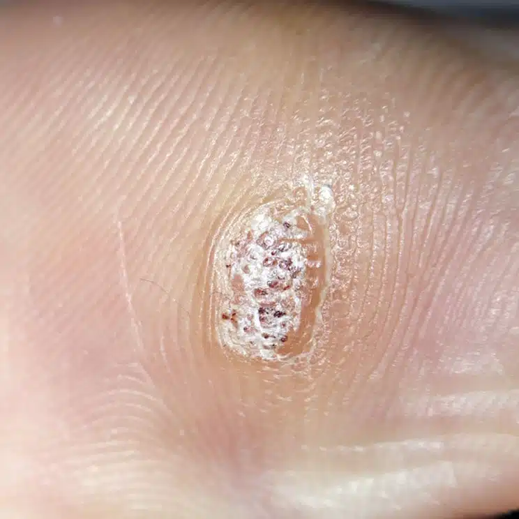 wart removal treatment